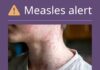 HEALTH ALERT: Measles exposure in Toowoomba