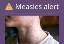 HEALTH ALERT: Measles exposure in Toowoomba